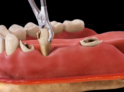 ROMDENT | Удаление нескольких зубов: плюсы и минусы