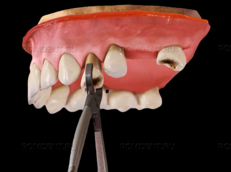 ROMDENT | Удаление верхних зубов – безопасно и безболезнено
