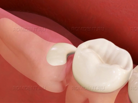 ROMDENT | Ретинированный зуб – когда задерживается прорезывание зубов