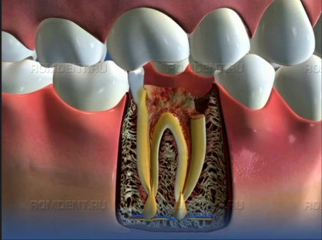 ROMDENT | Удаление зуба с осложнениями: правильная тактика