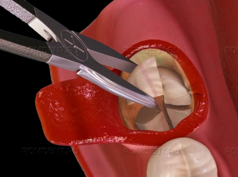 ROMDENT | Удаление зуба восьмерки – профессионально и быстро