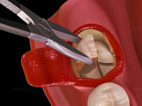 ROMDENT | В каких случаях нужно удалять «зуб мудрости»?