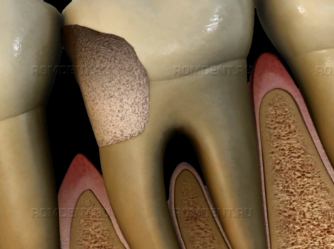 ROMDENT | Удаление зубов: показания и методики