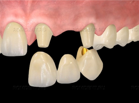 ROMDENT | Уход за зубами из металлокерамики