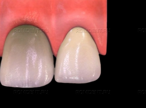 ROMDENT | Внутриканальное отбеливание зубов (эндоотбеливание)