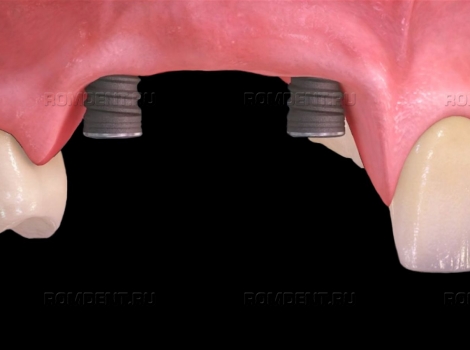 ROMDENT | Возможные осложнения после имплантации зубов