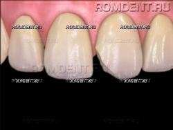 ROMDENT | Реставрация зубов