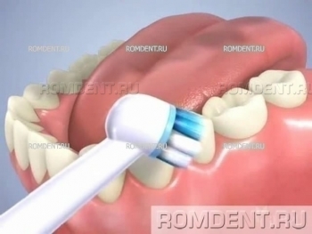 ROMDENT | Gum Treatment and Prevention
