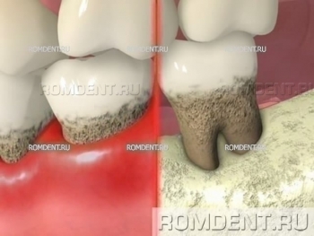 ROMDENT | Gum Treatment and Prevention