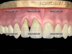 ROMDENT | Повышенная чувствительность зубов