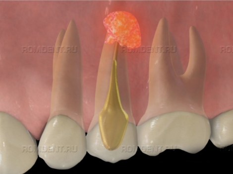 ROMDENT | Киста зуба – лечение, симптомы