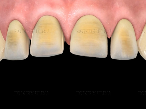 ROMDENT | Флюороз зубов — симптомы и лечение