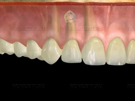ROMDENT | Лечение воспалившегося зуба инновационными методами