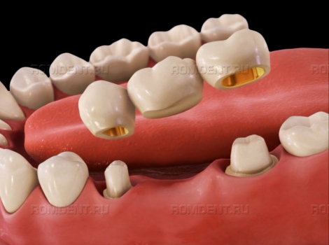 ROMDENT | Несъемное протезирование зубов: какие конструкции выбрать