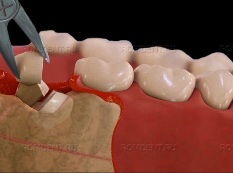 ROMDENT | Удаление нижних зубов у профессионалов