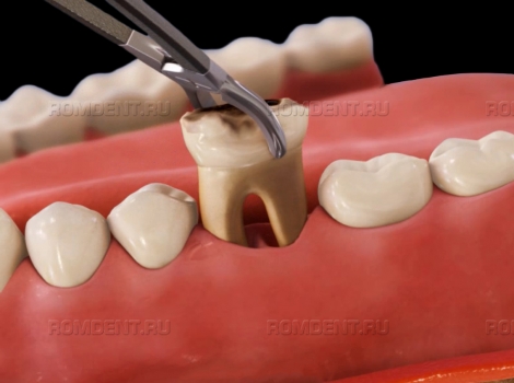 ROMDENT | Удаление зубов под наркозом: для кого и как?