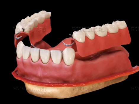 ROMDENT | Установка съемных зубных протезов: преимущества и недостатки